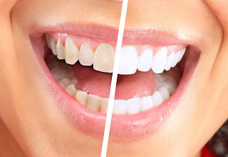 Q&A: Dr. Jeffrey Rappaport On Teeth Whitening