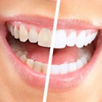 Q&A: Dr. Jeffrey Rappaport On Teeth Whitening